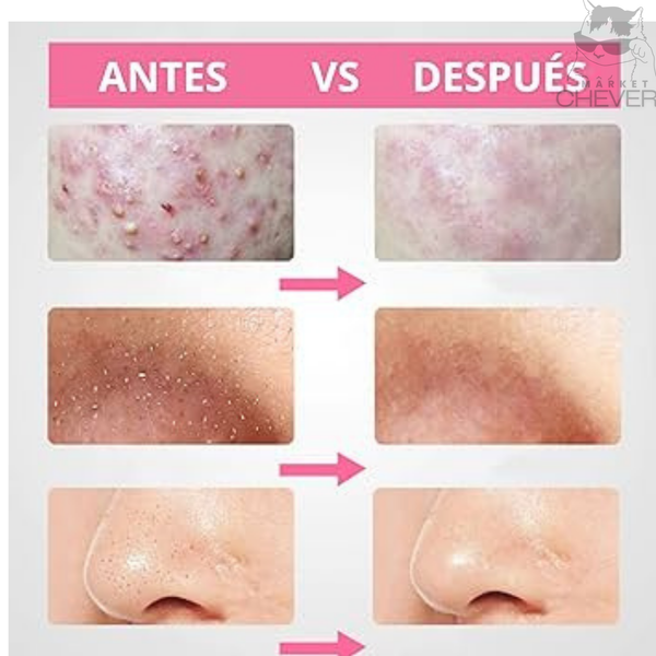 Aspirador Facial Milagroso