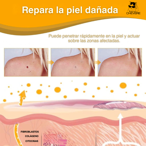 SKIN CLEAN SPRAY™ Spray Mágico para Verrugas