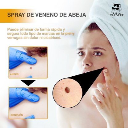 SKIN CLEAN SPRAY™ Spray Mágico para Verrugas