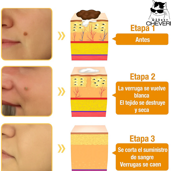 SKIN CLEAN SPRAY™ Spray Mágico para Verrugas