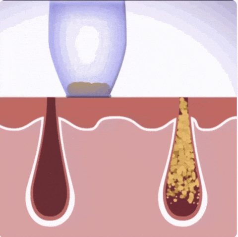 Aspirador Facial Milagroso