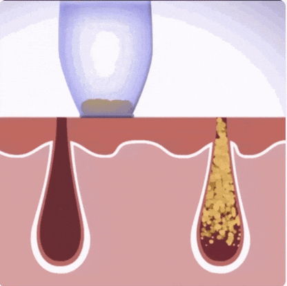 Aspirador Facial Milagroso